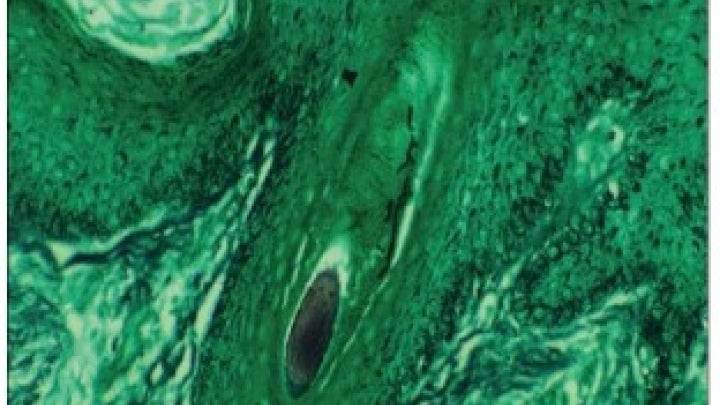 Hair follicle fungus